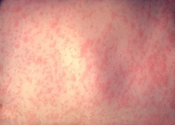 morbillivirus measles infection scaled e1708556336907